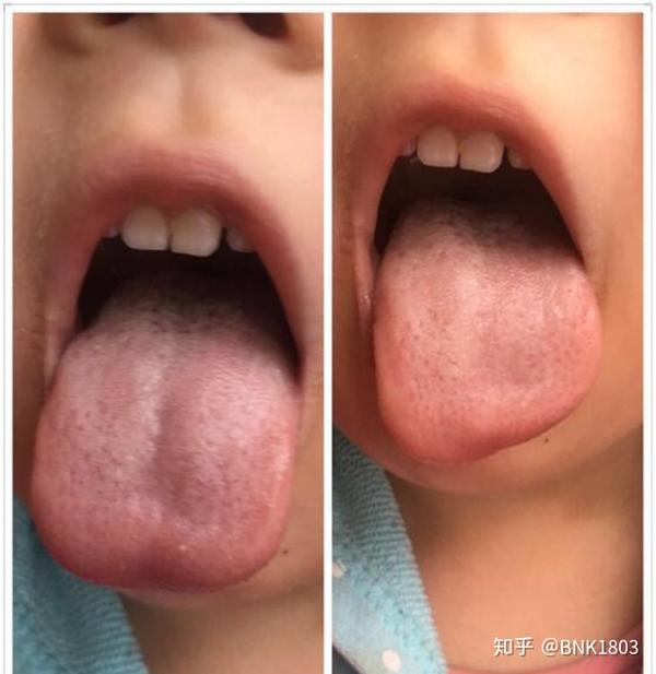 脾虚咳嗽的舌象
