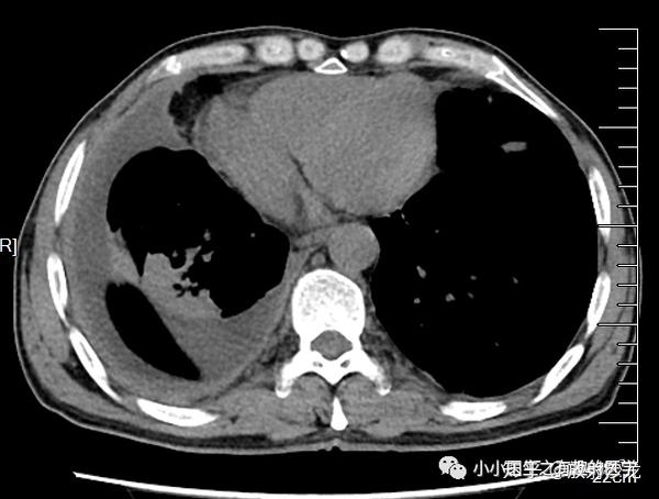 外院示左侧大量胸腔积液,右侧没有明显胸水!