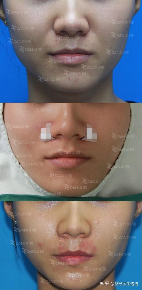 做过假体后感觉鼻基底还是凹陷怎么办?