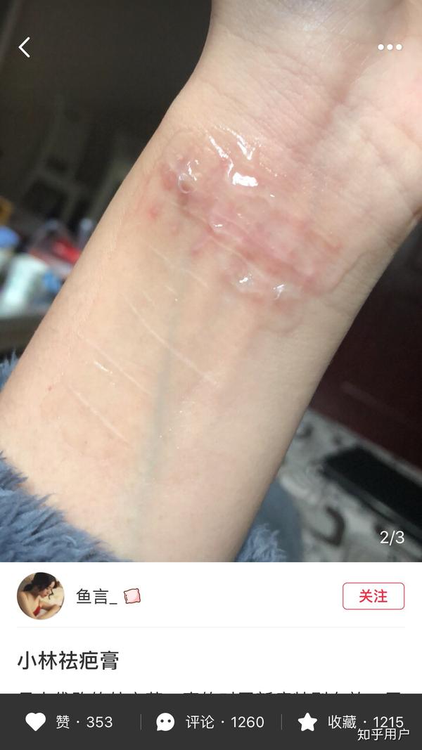 十天前腿部烫伤 面积很大 之后感染 至今未结疤 想先求祛疤膏 毕竟