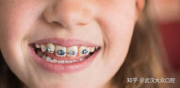 孩子新换的牙齿长歪了怎么办?