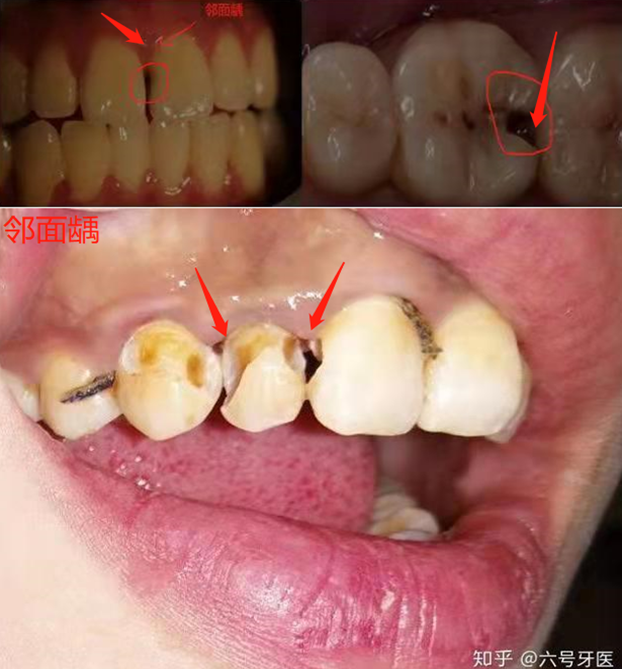 如何享受牙齿变美的过程牙齿矫正人群口腔清洁指南