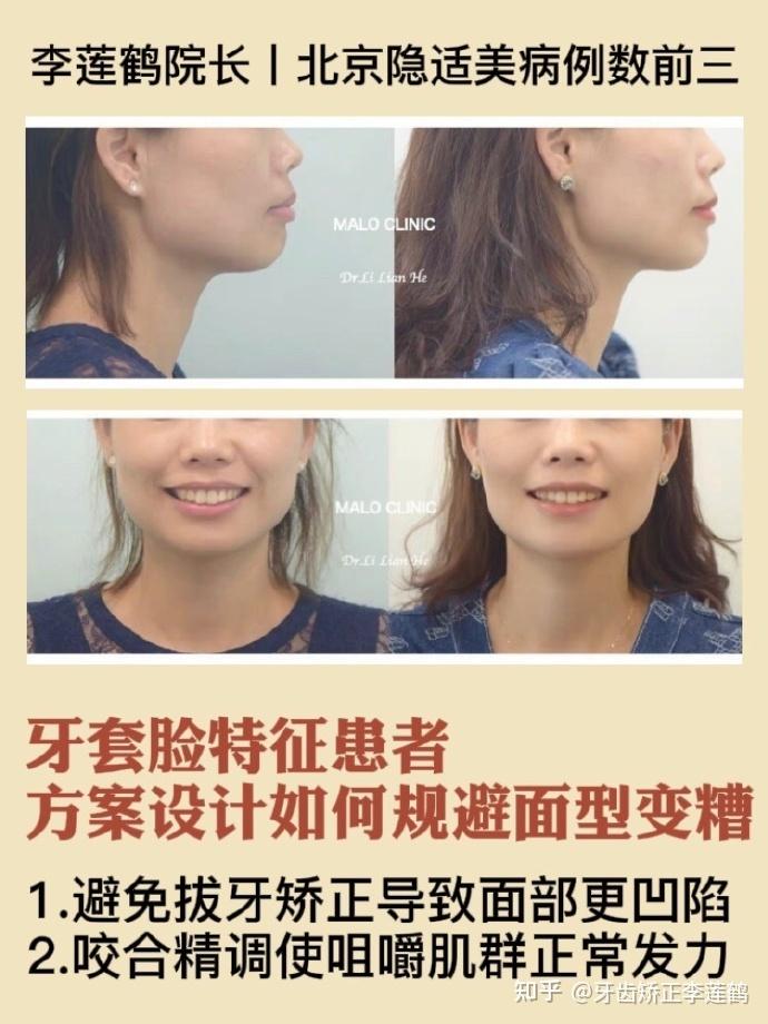但拔牙对于她的面型并不友好,可能会让面部更加凹陷,所以我们利用后牙