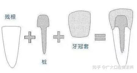 为什么做了根管治疗医生建议给牙齿打桩?怎样的牙齿需要打桩呢?