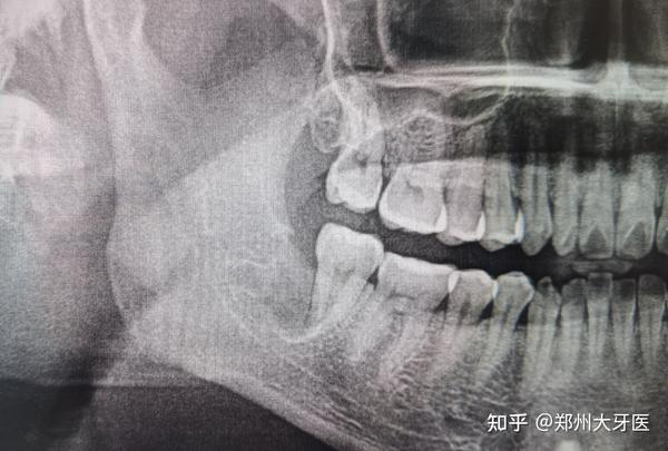 骨埋伏智齿拔出