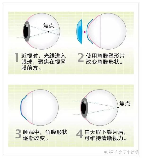 ok镜是眼科临床上公认的健康的近视矫正选择,也是对18岁以下的青少年