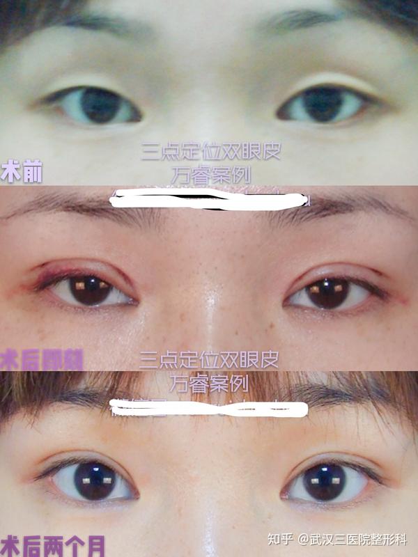 双眼皮术后初期出现不对称,肿,淤青该怎么办?
