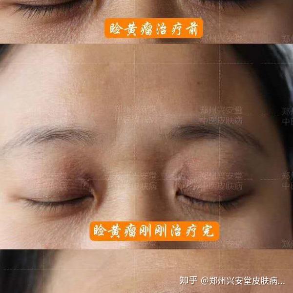 长了睑黄瘤有哪些注意事项呢?