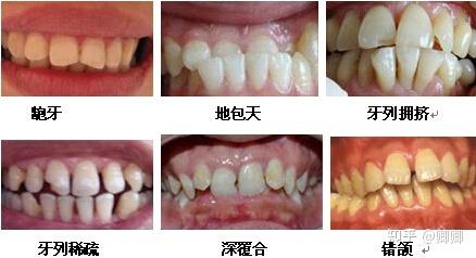 据统计,中国有超过89%的人牙齿畸形的情况,畸形的牙齿影响的不仅是