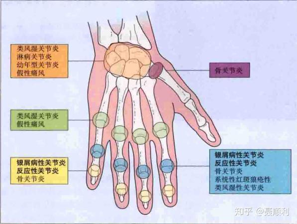 类风湿关节炎是什么样的疾病?