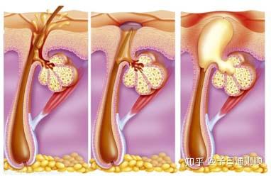 皮脂腺分泌过量堵塞毛孔过程
