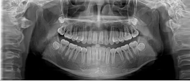 【修正数字口腔】口腔全景片到底有什么用?