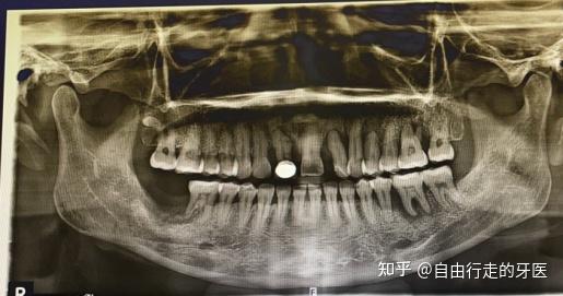 现在有几颗牙牙槽骨吸收三分之二了,没有办法保住,只能拔除然后种植