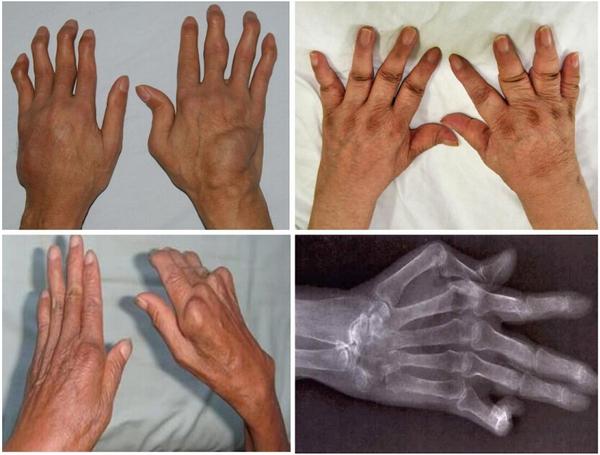 图3-1 类风湿性关节炎最常见的手指关节