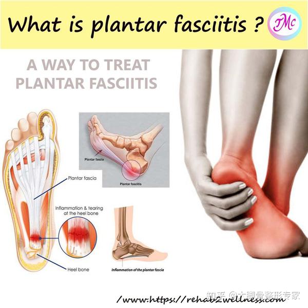 足底疼痛严重可能是足底筋膜炎惹的祸