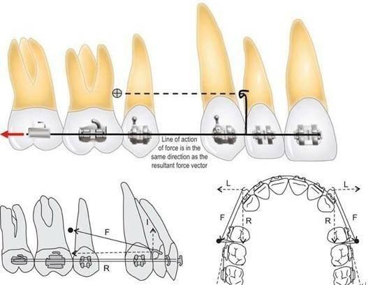 牙齿矫正支抗钉可以让骨头内收解决骨性畸形