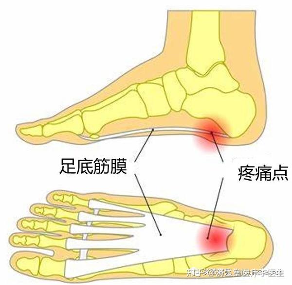 关节研究/ joint research 脚底板疼痛是医生在门诊经常遇到的疾病
