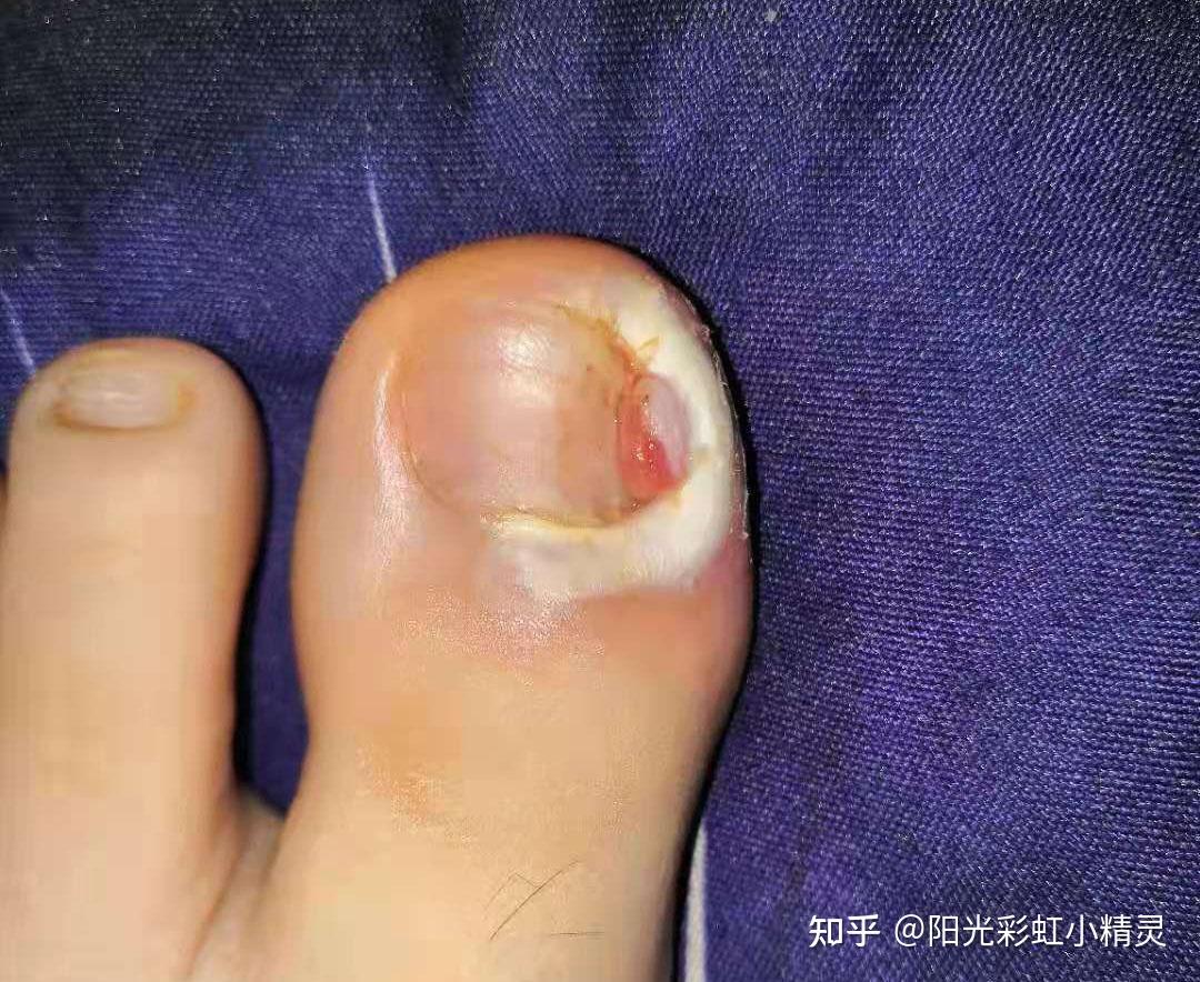 甲沟炎剪完了指甲不扎肉但是息肉肿大覆盖指甲.