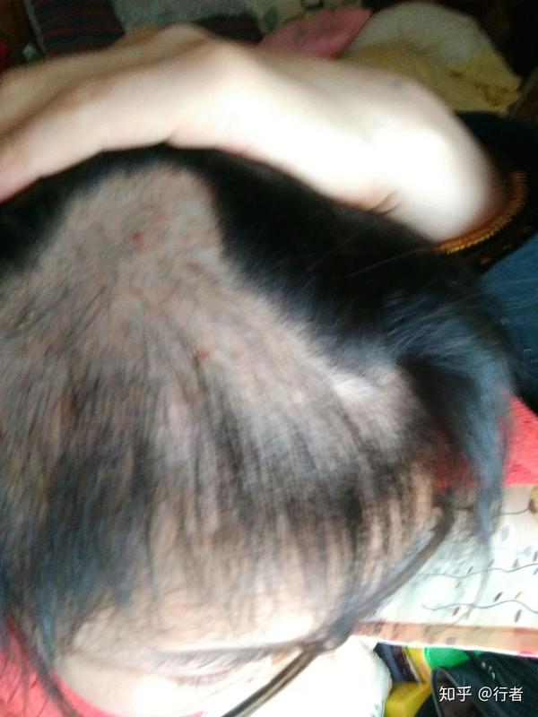 拔毛癖的自救之路