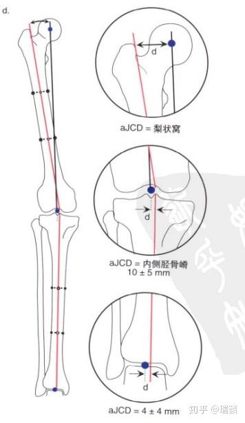 下肢矢状面解剖轴及关节走行方向角