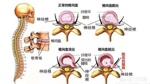 腰椎间盘突出可以治好吗