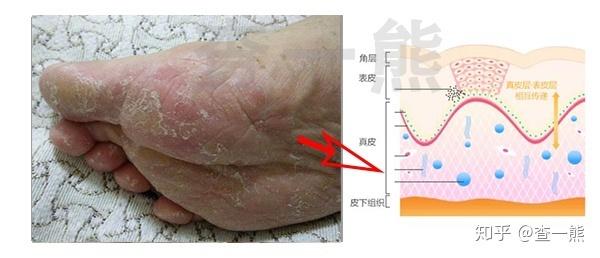 有图脚后跟这个是脚癣吗