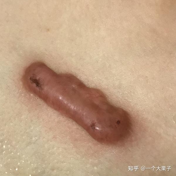 胸口的疤突然下方有几个小痘痘,摸起来很痛,好担心会是新的疙瘩