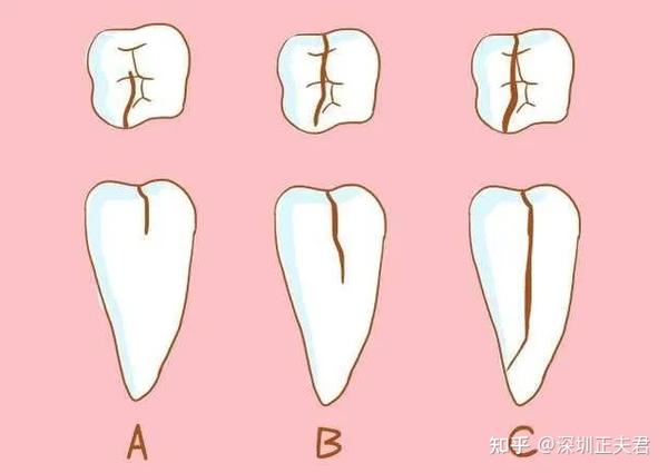 牙齿裂了怎么办?帮你分析牙裂原因