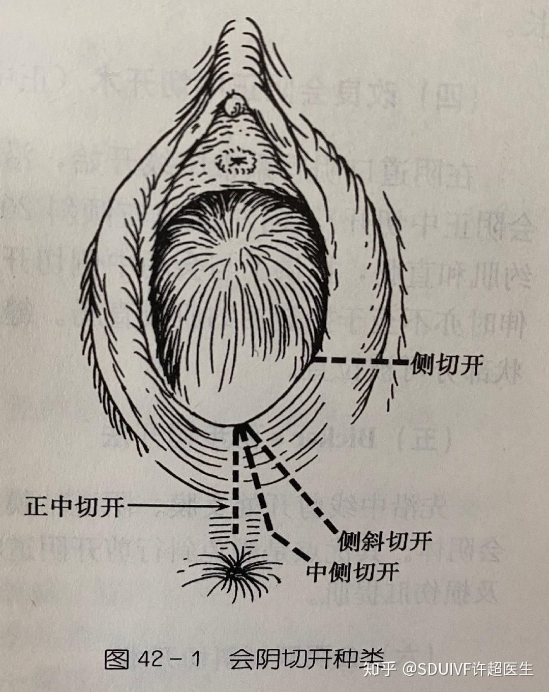 会阴侧切开术是从中间横着切开,这个切开的过程切断的组织比较多,甚至