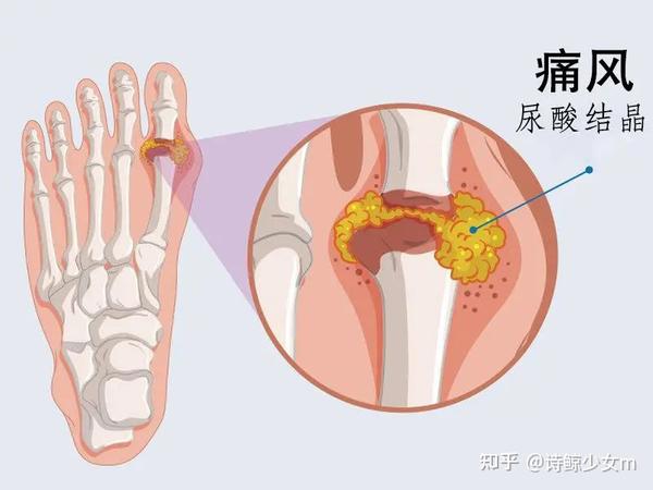 尿酸高多少才是痛风?