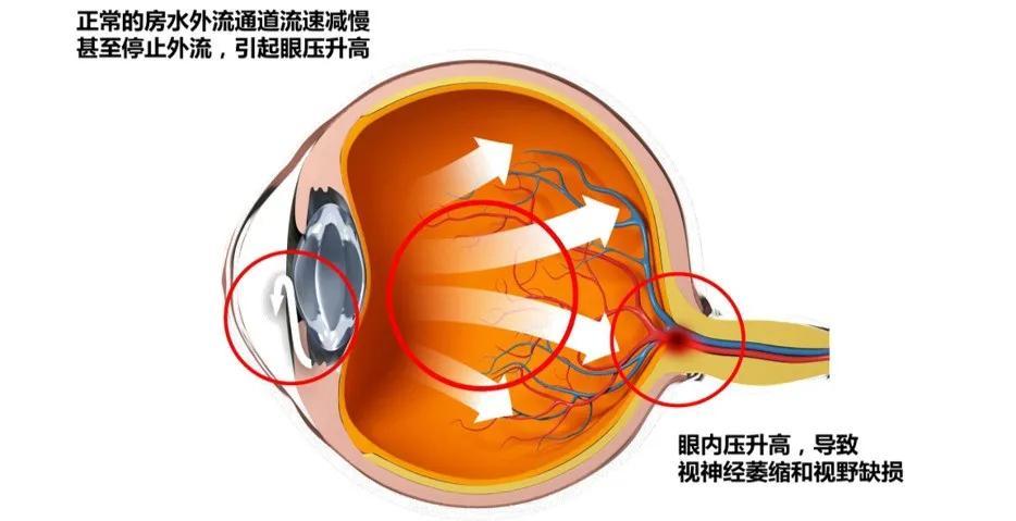 如果房水排出通道——房角阻塞,房水排出受阻,就会引起眼压升高.