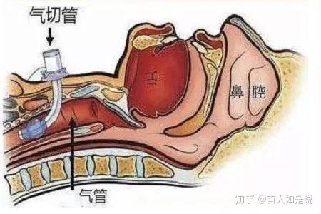 首大计成气管切开并不可怕居家更换消毒套管要注意什么