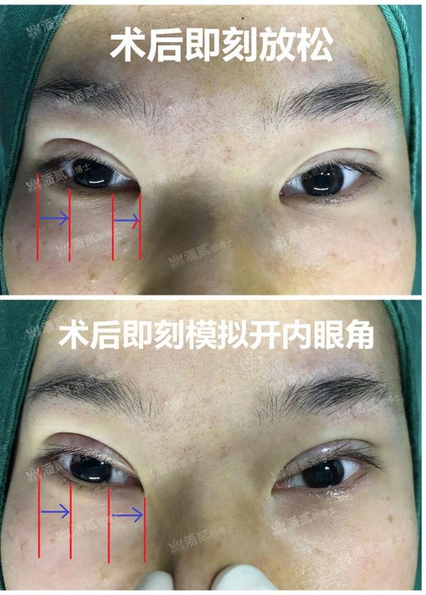 这个程度(参考用手扒的模拟效果图),会不会感觉内眼角处的眼白太多了?