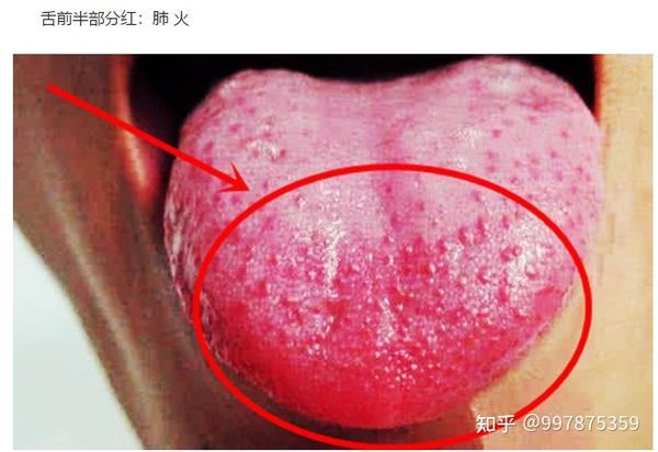 望闻问切阴虚阳虚气虚血虚上火用要辩证舌头治疗