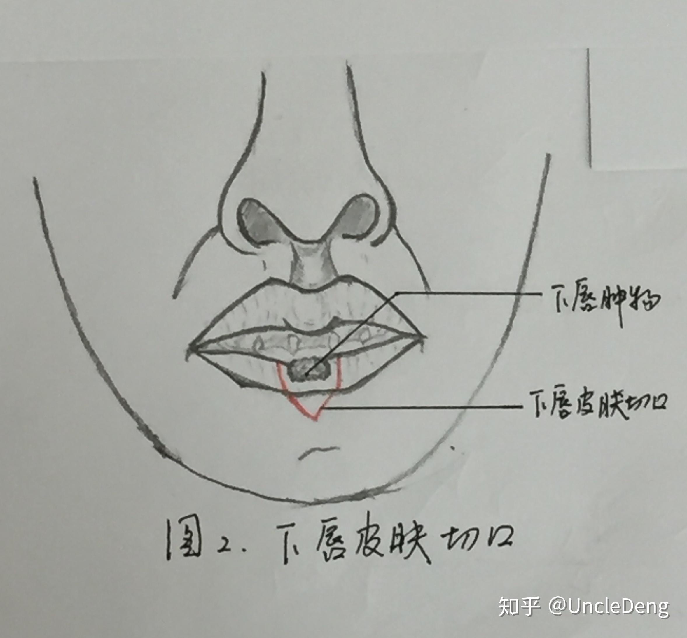 一是上唇瓣制取时,要小心操作,避免损伤蒂部极为细小的唇动脉穿支;本