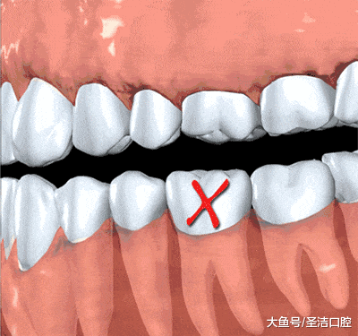 经常用一侧牙齿咀嚼会怎么样呢?