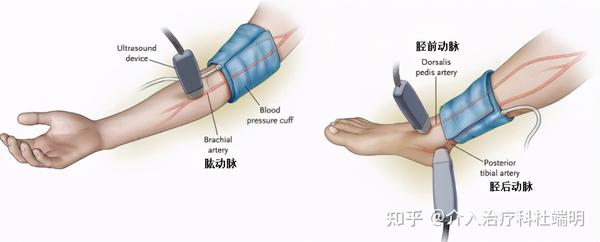 老人腿麻,怕冷,谨防下肢动脉硬化闭塞症!