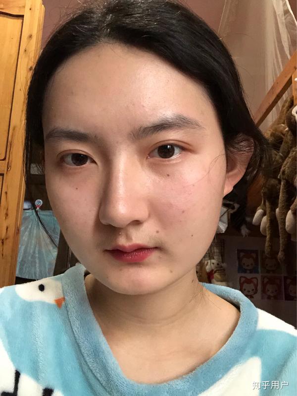 脸上长很多痣是一种怎样的体验?