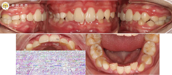 『正畸病例』替牙期矫治病例 1 例