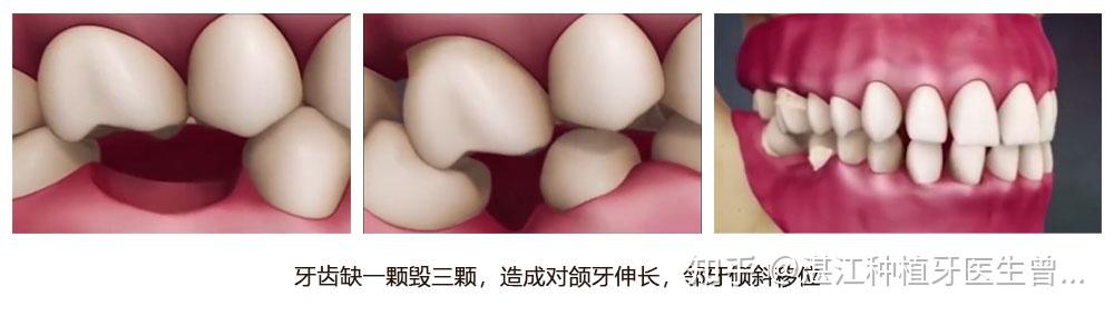 缺牙时间过长,导致对颌牙伸长,邻牙因失去依靠和束缚,倾斜移位,加剧