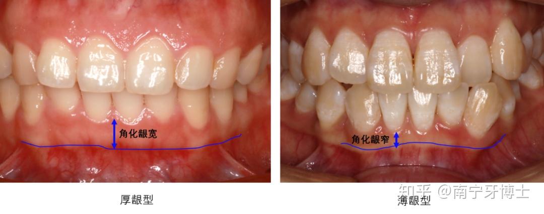 厚型牙龈的牙冠接近方圆形,角化龈较宽;而薄龈型的牙冠一般较为狭长