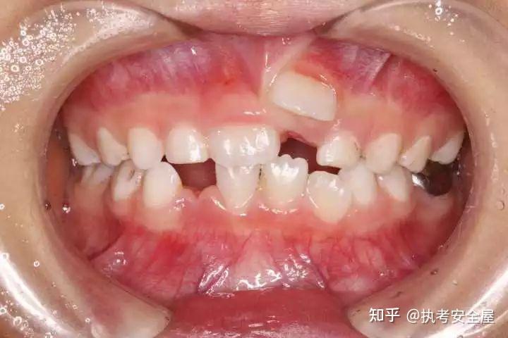 科普双排牙是什么现象宝爸宝妈必看