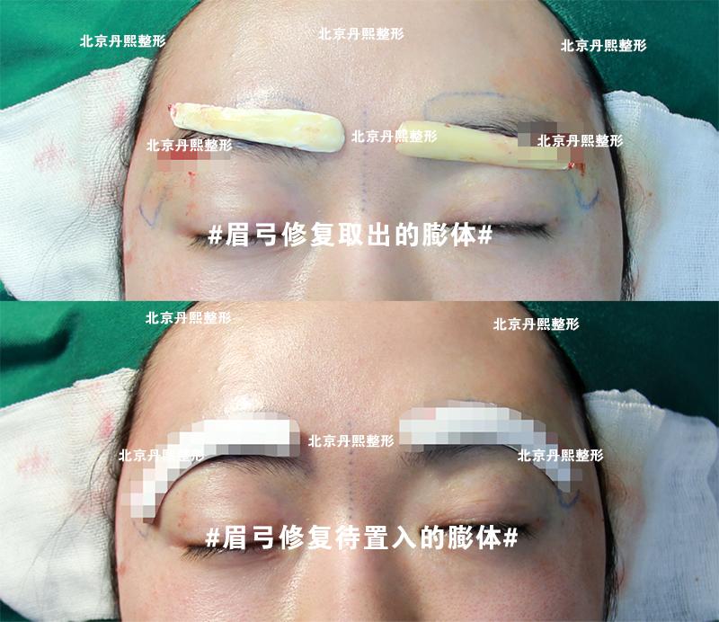 魏洁谈眉弓通过一例眉弓修复来了解假体丰眉弓的手术全过程
