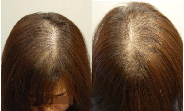 女性主要表现为头顶部头发逐渐变细,减少,但前额发际线位置不改变.