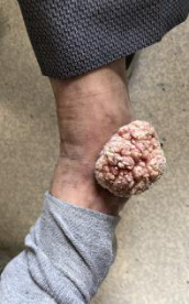 脚踝上的一颗"花菜"——疣状癌