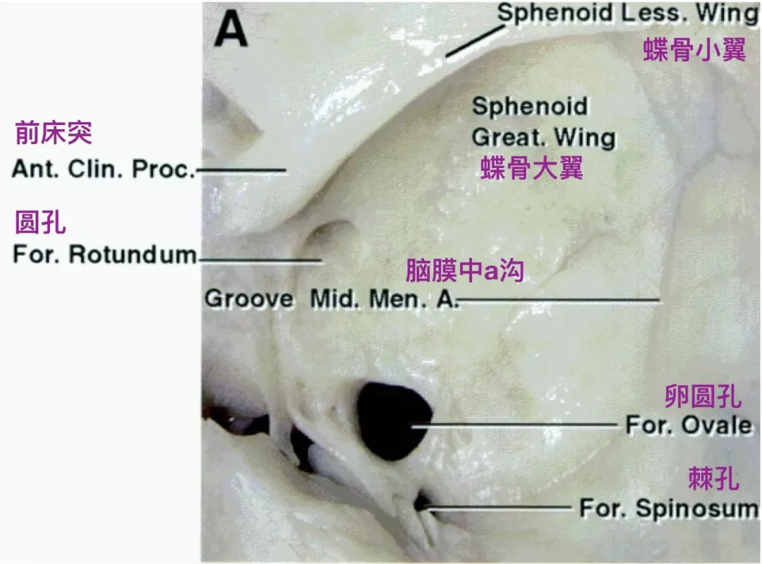脑膜中动脉额支骨沟从棘孔处延伸到蝶骨嵴(liu 2001.