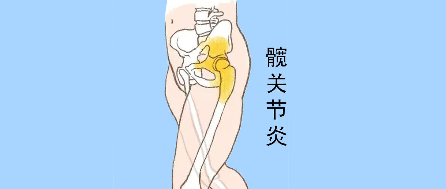 他的髋关节炎是怎么康复的?