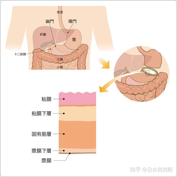 中心部叫胃体,出口为幽门, 连接着十二指肠 胃癌是由于胃壁内侧粘膜细