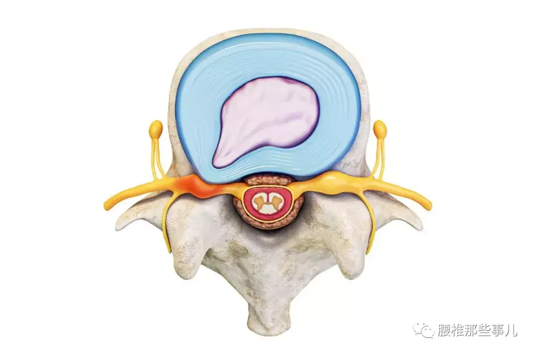 椎间盘膨出怎样防止变成突出呢