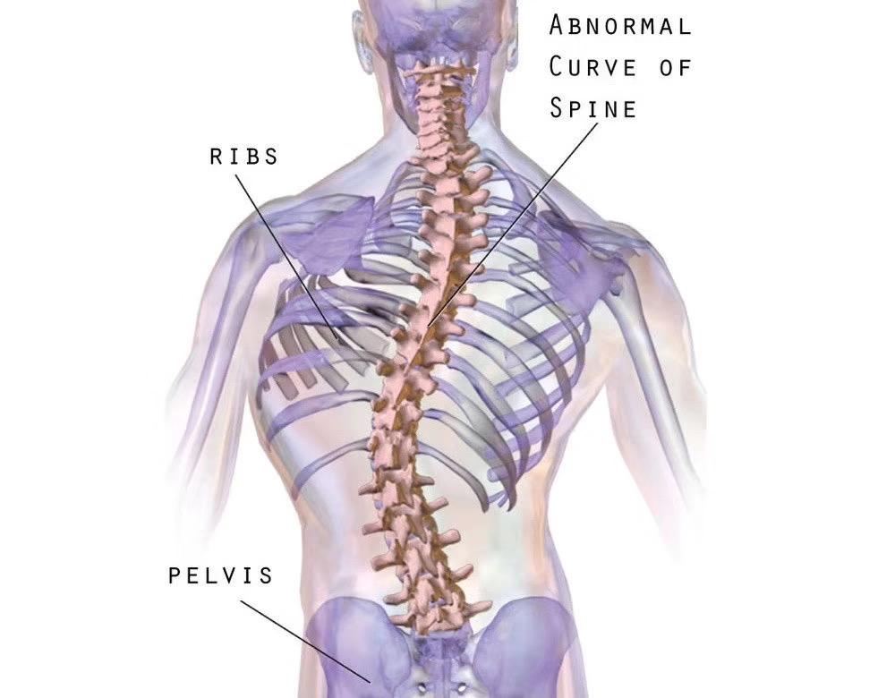 脊柱侧弯就是从背后看上去脊柱的曲线呈现c型或s型,与健康正常的脊柱